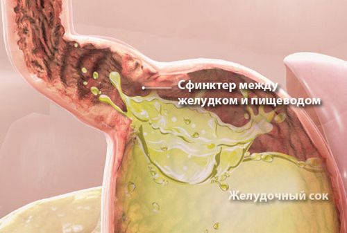 Ką daryti, jei turite rėmuo