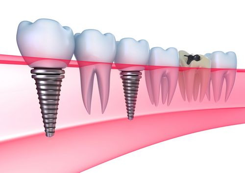 Ar dantų implantacija yra prabanga ar būtinybė? 