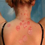 Kaip gydyti psoriazę? Kaip gydyti psoriazę?