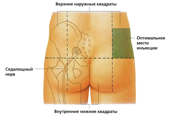 Kaip injekuoti į raumenis į sėdmenis