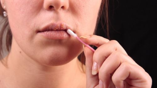 Veiksmingi peršalimo nuo lūpų gydymo būdai