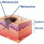 Odos melanoma