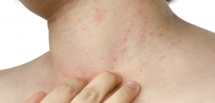 Ką sukelia bėrimas ant kaklo: pagrindinės priežastys ir gydymo metodai
